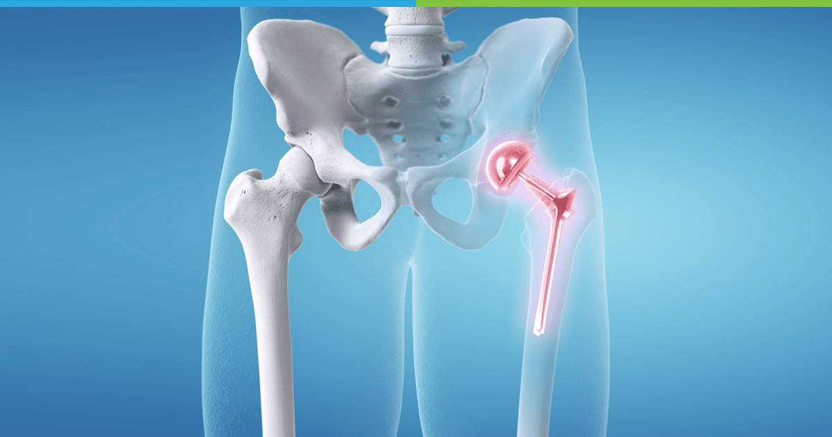 Hip Replacement and Knee Replacement Surgery