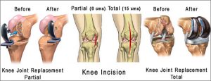 Total Knee Replacement