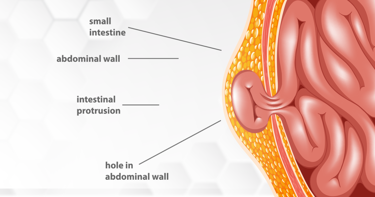 Can A Hernia Cause Gastric Problems