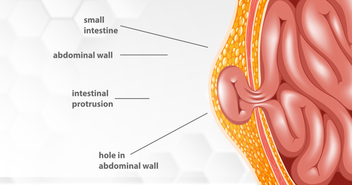 Causes and Symptoms of Hernia