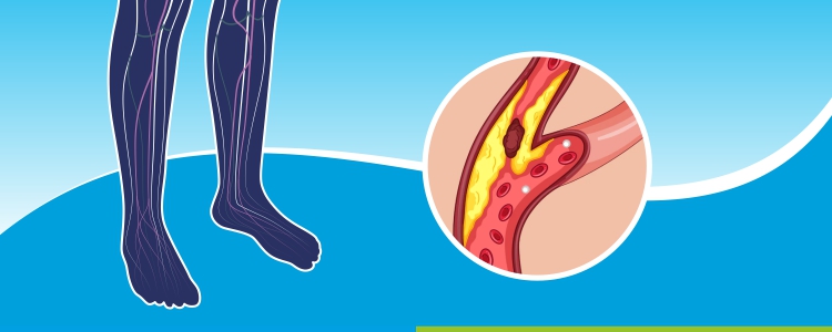 Peripheral Arterial Disease (PAD)