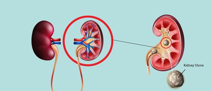 Kidney Stone Diagram