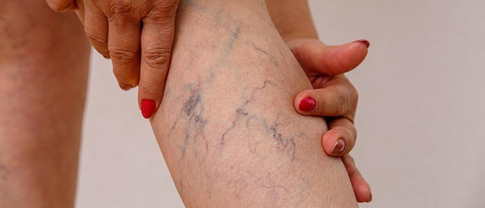 What is Varicose Veins (spider)?: Myths you should know