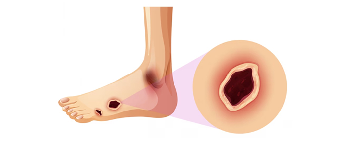 4 Diabetic Foot Infections Causes Symptoms And Treatment Omni Hospitals 7869