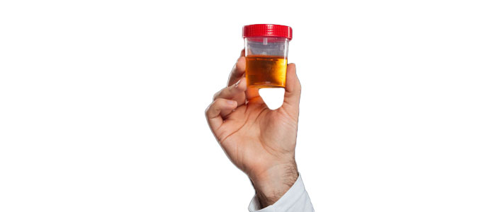 Urine Brown Discharge, Blood in the urine can look pink, red or  cola-colored.