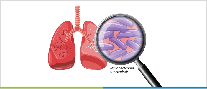 Tuberculosis (TB): Symptoms, Causes, Diagnosis, Treatment