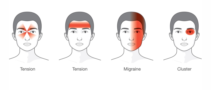 Types of Headaches